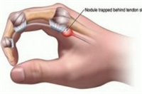 NGÓN TAY CÒ SÚNG (NGÓN TAY BẬT) - VIÊM BAO GÂN GẤP NGÓN TAY